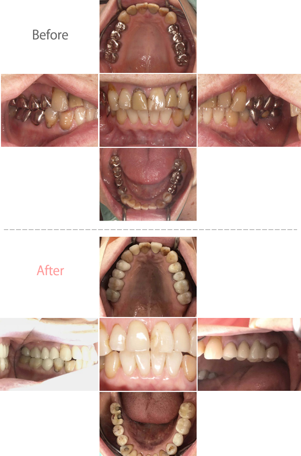 オールセラミック冠
