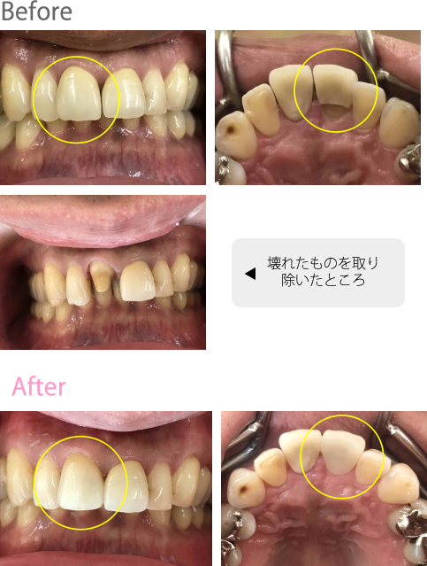 オールセラミック冠