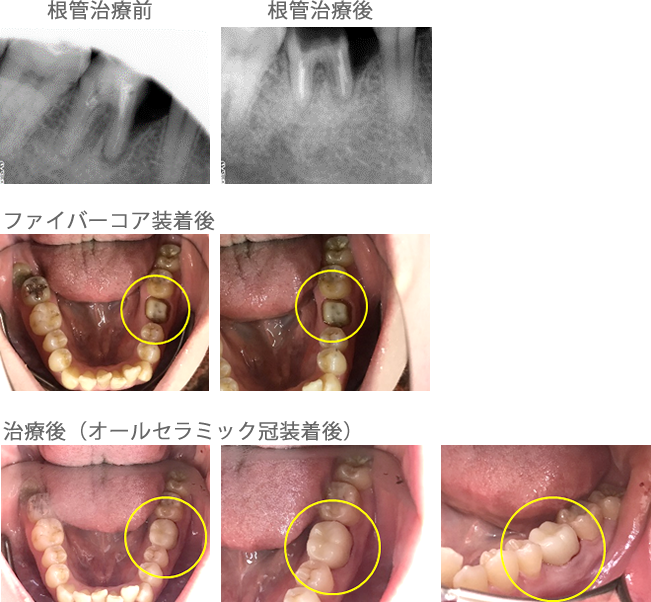 オールセラミック冠