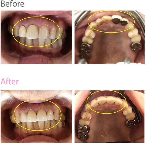 オールセラミック冠