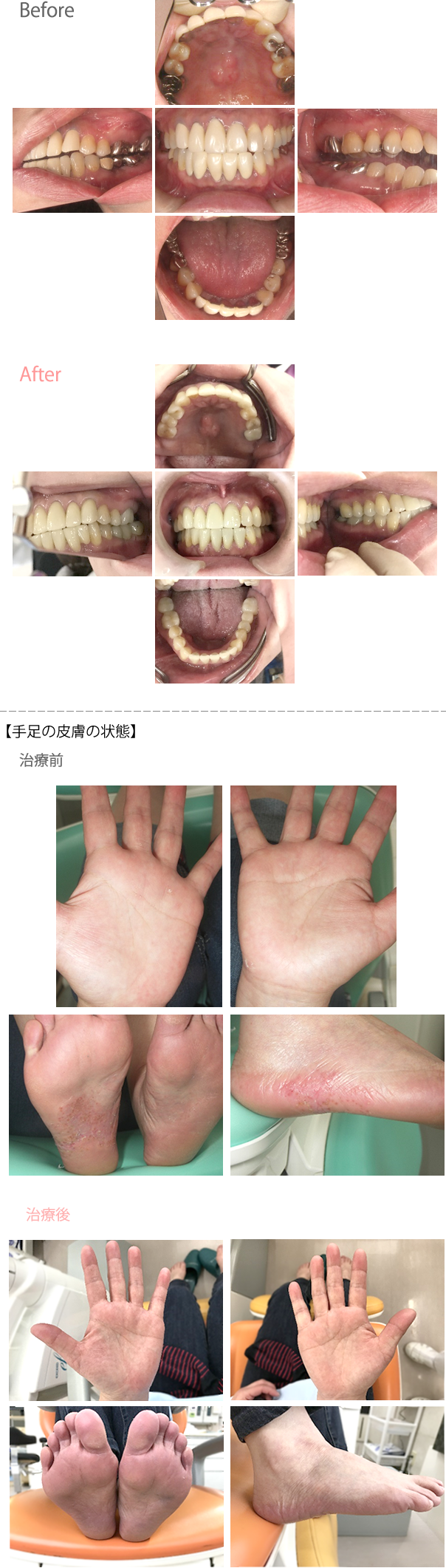 オールセラミック冠