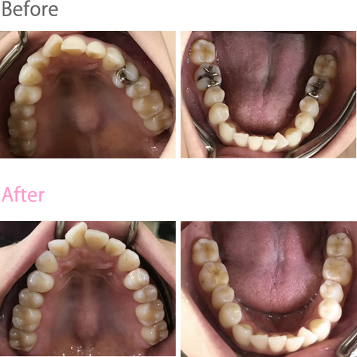 オールセラミック冠