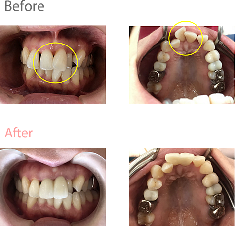 オールセラミック冠