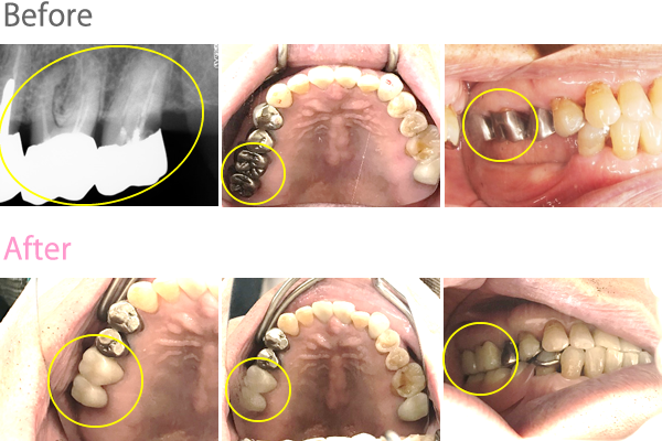 オールセラミック冠