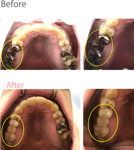 オールセラミック冠