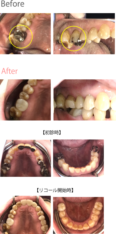 オールセラミック冠