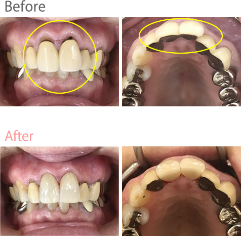 オールセラミック冠