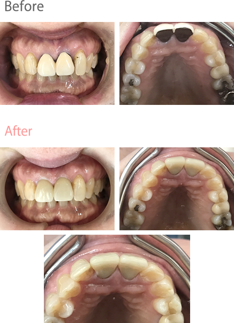 オールセラミック冠