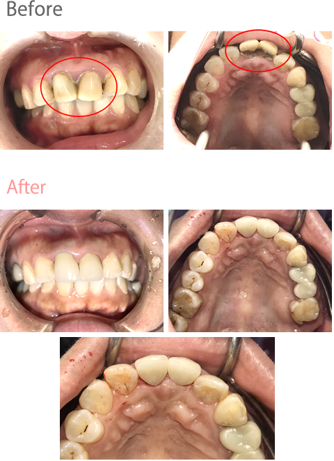 オールセラミック冠