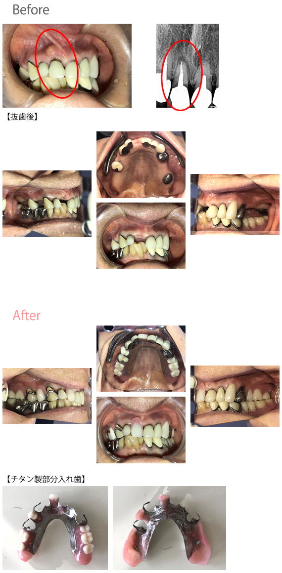 チタン製義歯