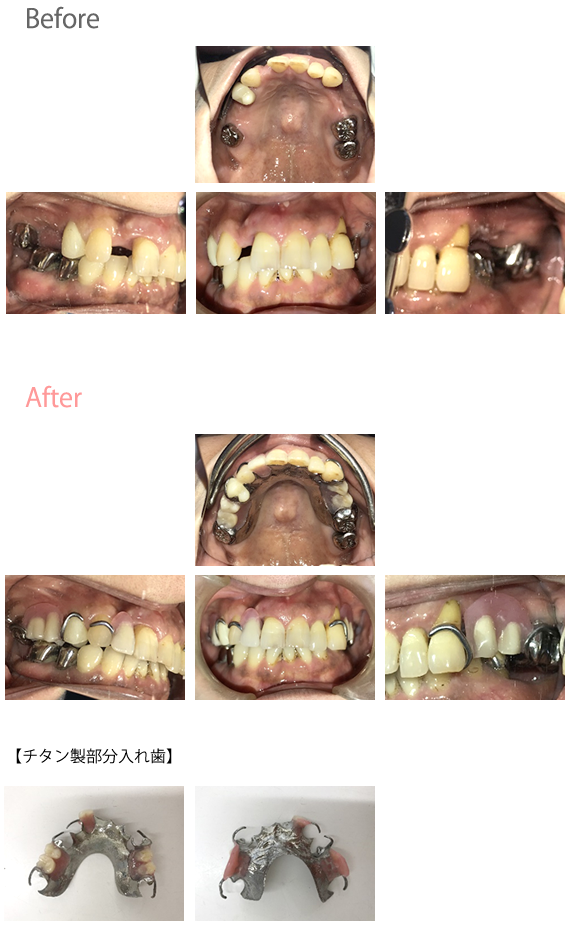チタン製義歯
