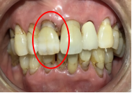 オールセラミック冠 治療前