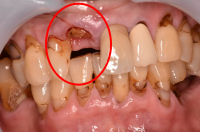 オールセラミック冠 治療前