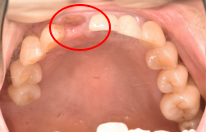 オールセラミック冠 治療前