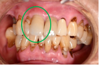 オールセラミック冠 治療後