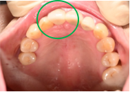オールセラミック冠 治療後