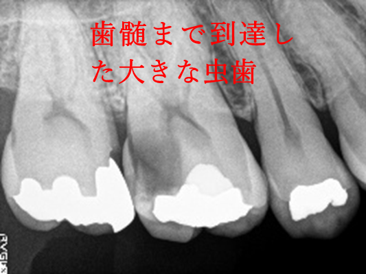 オールセラミック冠 治療前