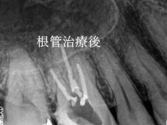 オールセラミック冠 治療前