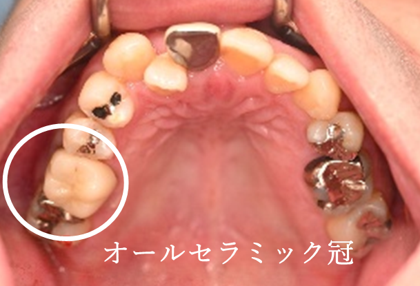 オールセラミック冠 治療後