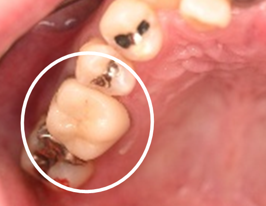 オールセラミック冠 治療後