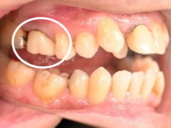 オールセラミック冠 治療後