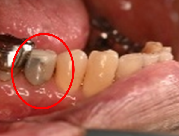 オールセラミック冠 治療前