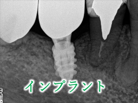 インプラント