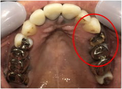オールセラミック冠 治療前