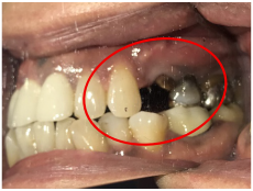 オールセラミック冠 治療前