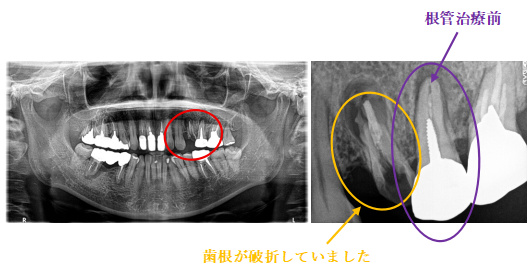 オールセラミック冠 治療前