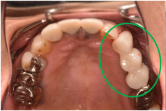 オールセラミック冠 治療後