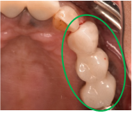 オールセラミック冠 治療後
