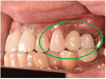 オールセラミック冠 治療後