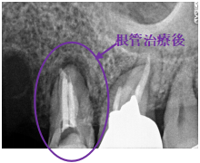 オールセラミック冠 治療後
