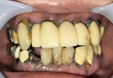 マグネット義歯