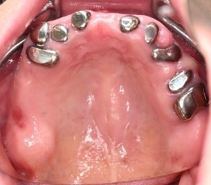 マグネット義歯