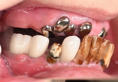 マグネット義歯