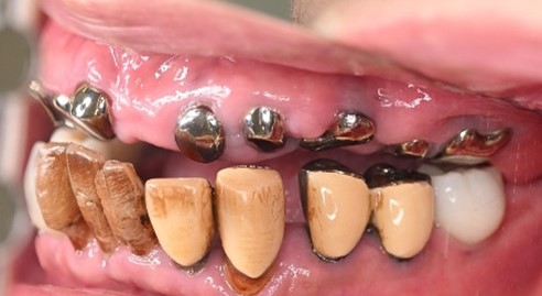 マグネット義歯