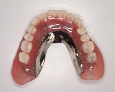 マグネット義歯