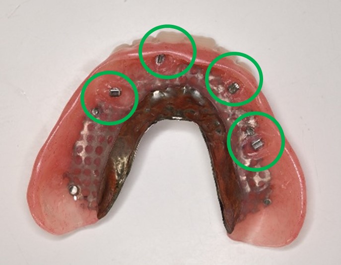 マグネット義歯