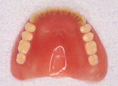 マグネット義歯