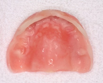 マグネット義歯