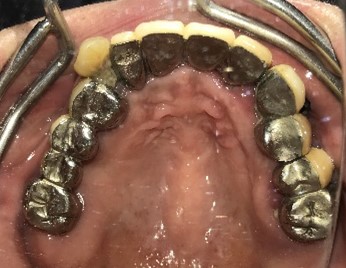 マグネット義歯