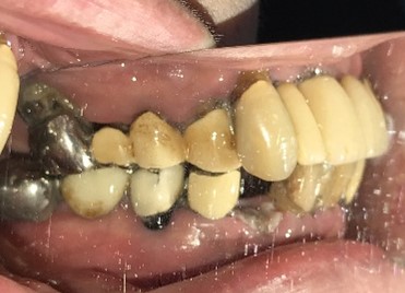 マグネット義歯