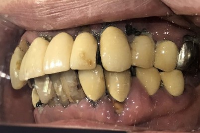 マグネット義歯