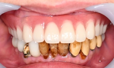 マグネット義歯