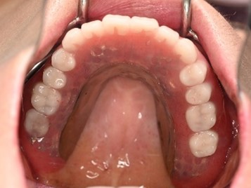 マグネット義歯