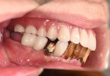 マグネット義歯