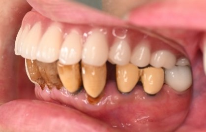 マグネット義歯