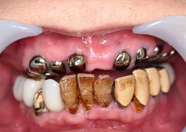 マグネット義歯